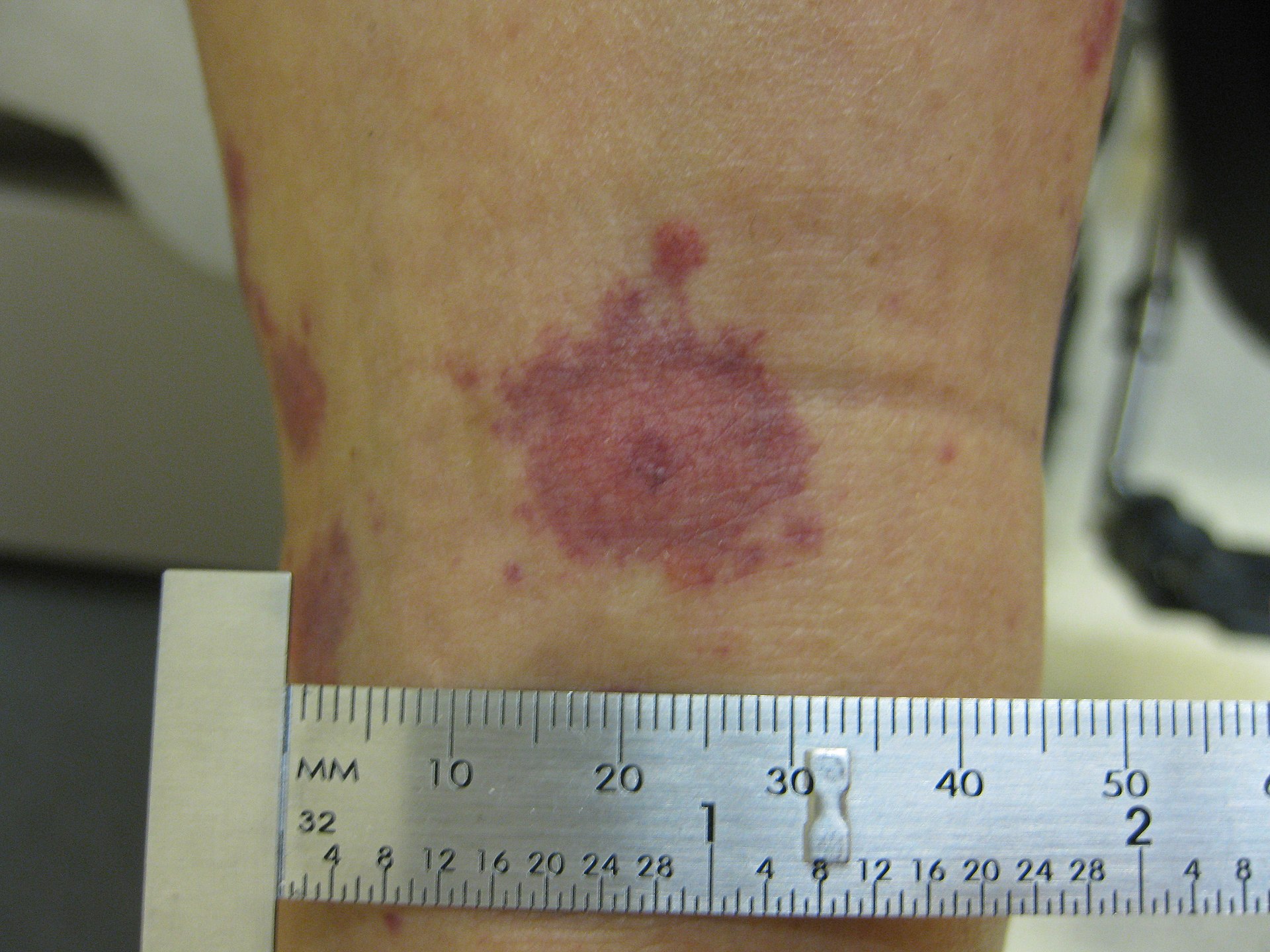 Erythema Multiforme