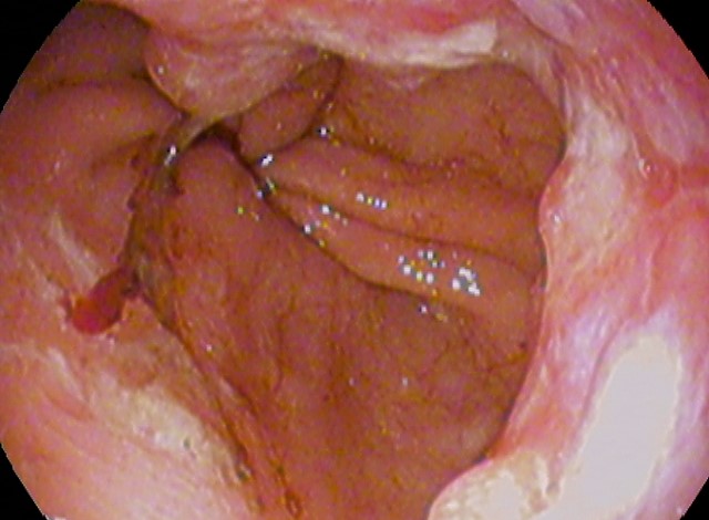 Esophageal Cancer