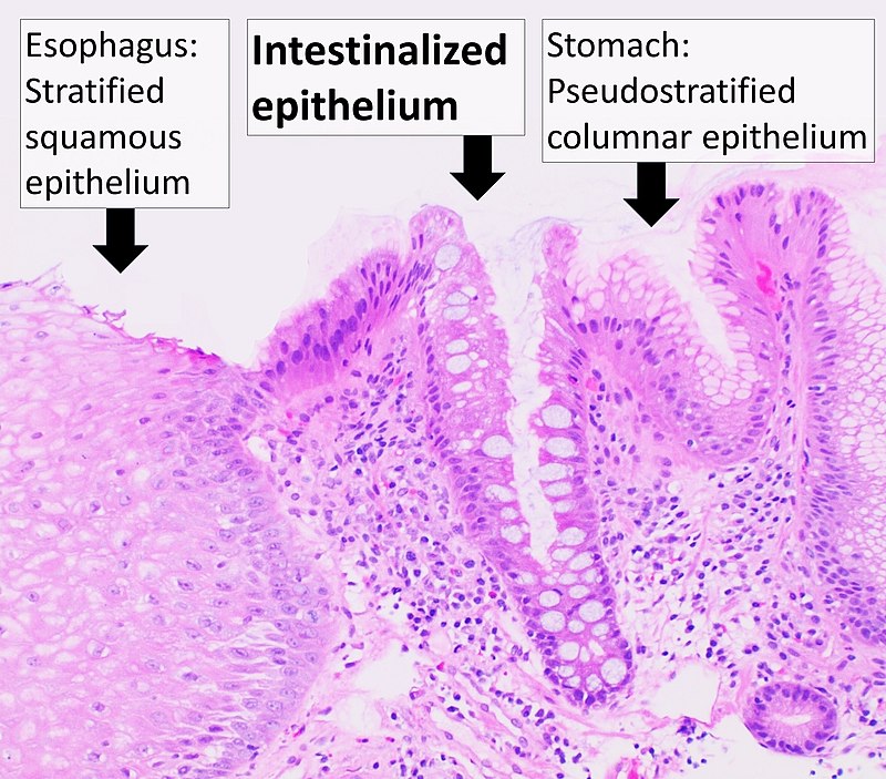 Esophagus Pathology