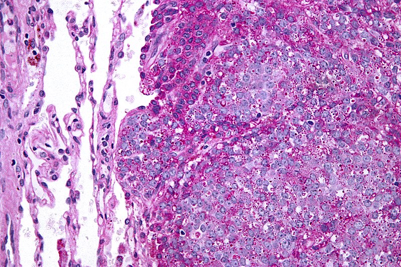 Ewing Sarcoma