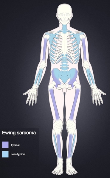 Ewing Sarcoma