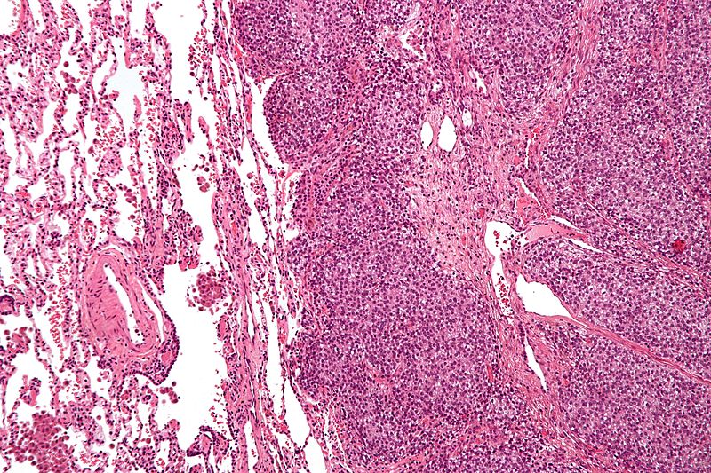 Ewing Sarcoma