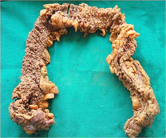 Familial Adenomatous Polyposis