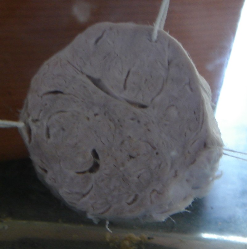 Fibroadenoma