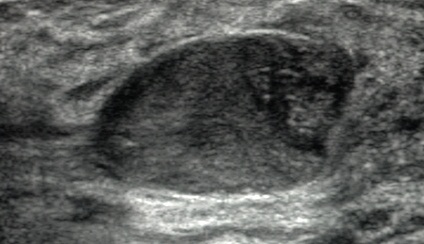 Fibroadenoma
