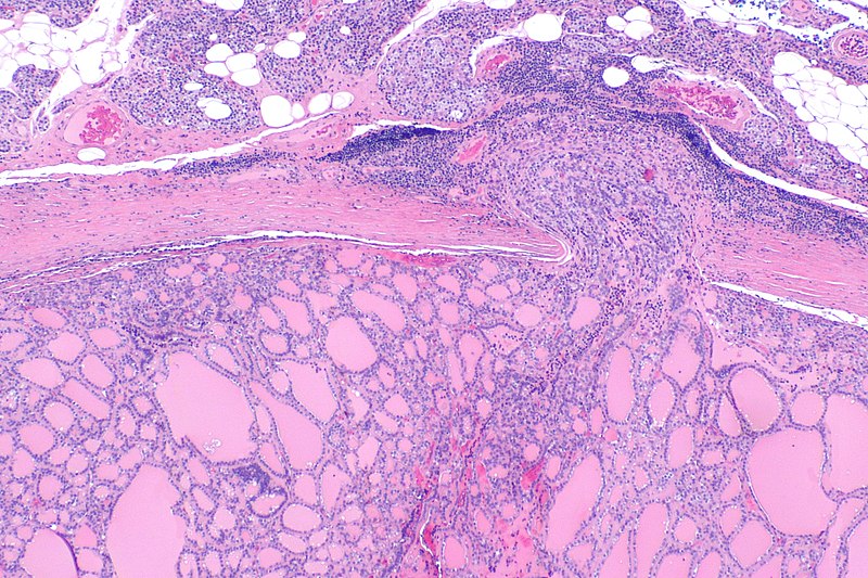 Follicular Thyroid Carcinoma
