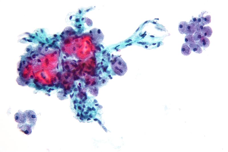 Follicular Thyroid Carcinoma