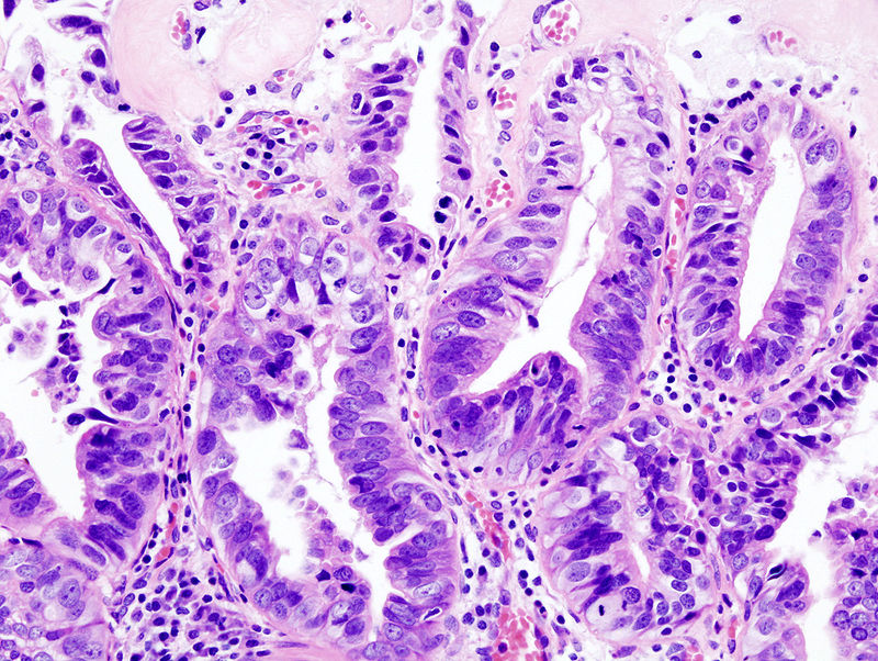 Gallbladder Carcinoma
