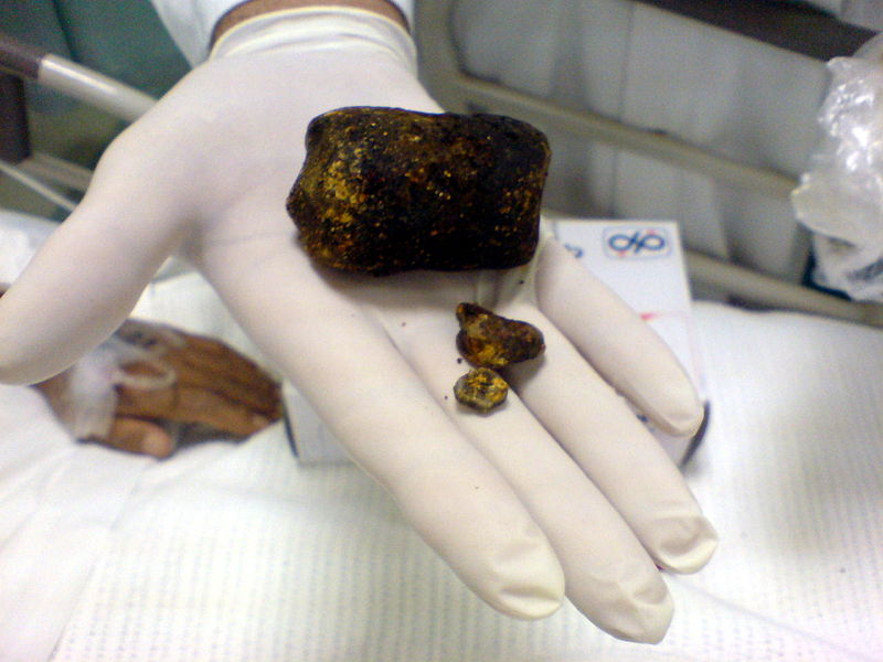 Gallstones