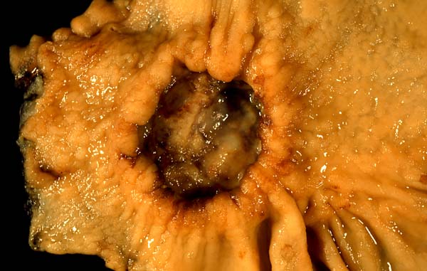 Gastric Carcinoma