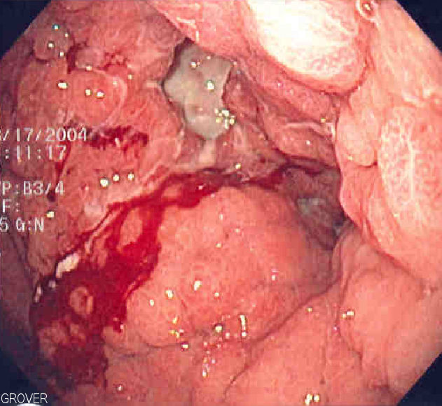 Gastric Carcinoma
