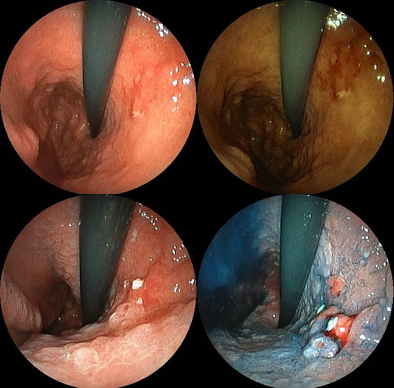 Gastric Carcinoma