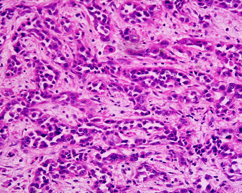 Gastric Carcinoma