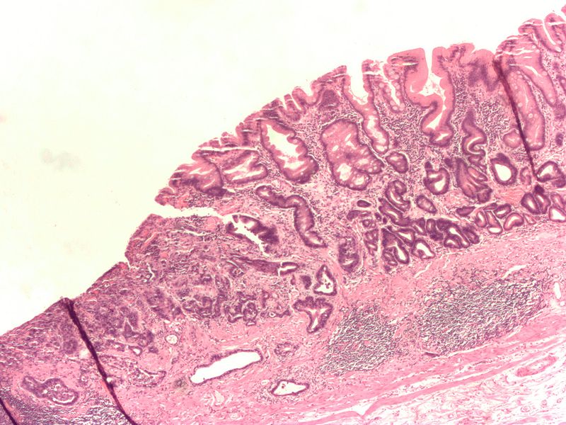 Gastric Carcinoma