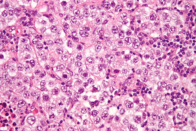 Germ Cell Tumors