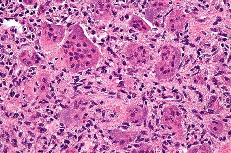 Giant Cell Tumor of the Bone