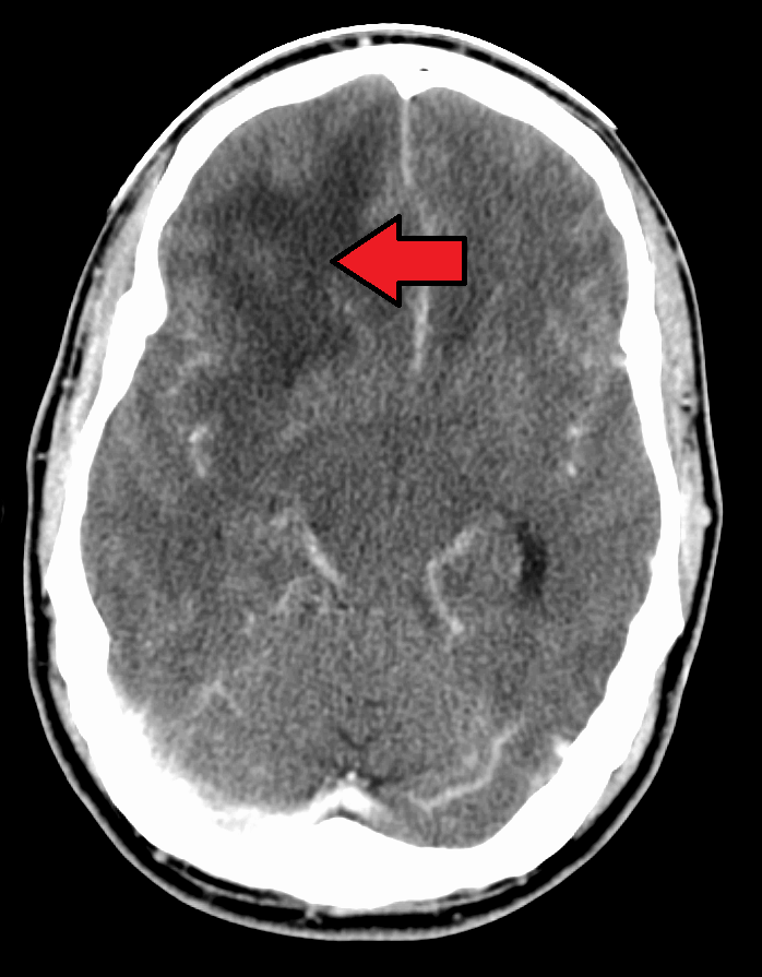 Glioblastoma Multiforme