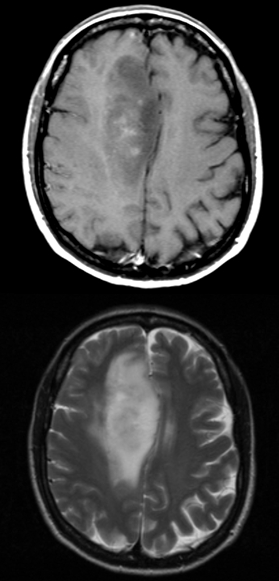 Glioblastoma Multiforme