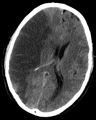 Global Cerebral Ischemia