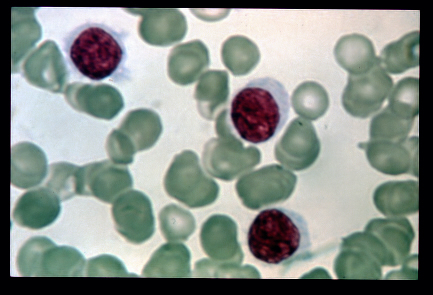 Hairy Cell Leukemia