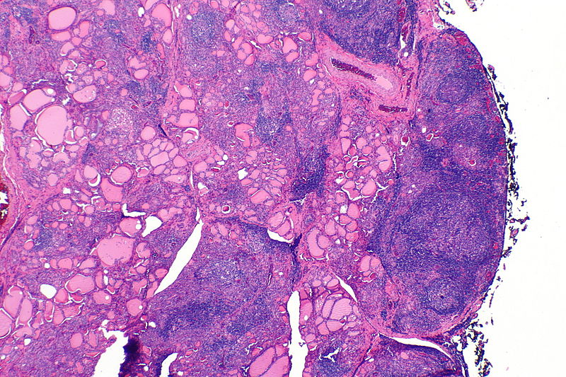 Hashimoto Thyroiditis
