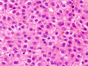 Hepatocellular Carcinoma