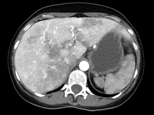 Hereditary Hemorrhagic Telangiectasia