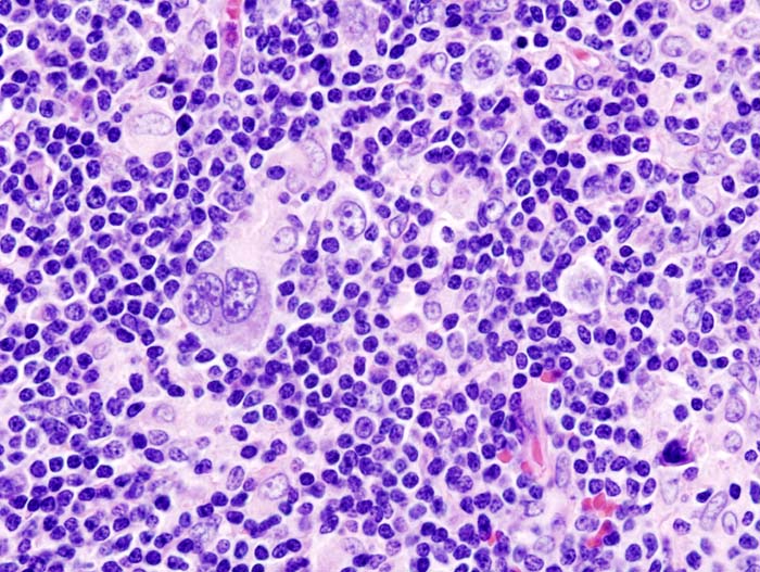 Hodgkin Lymphoma
