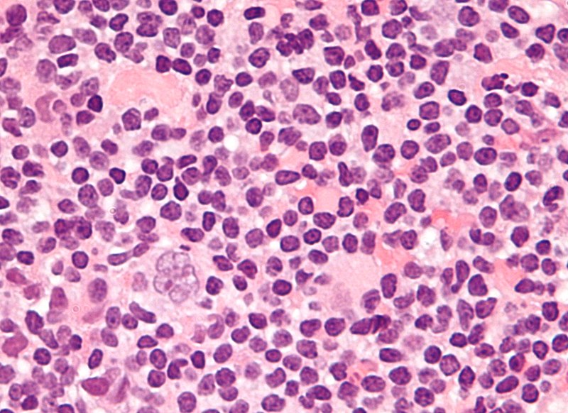 Hodgkin Lymphoma
