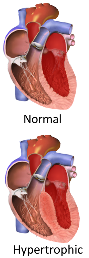 Hypertrophic Cardiomyopathy