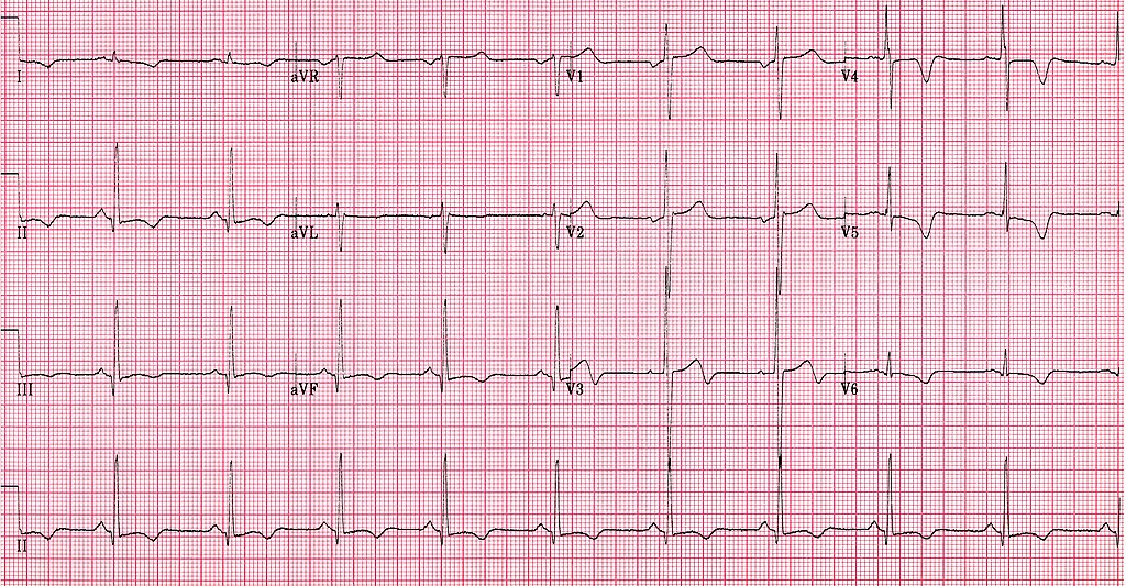 Hypertrophic Cardiomyopathy