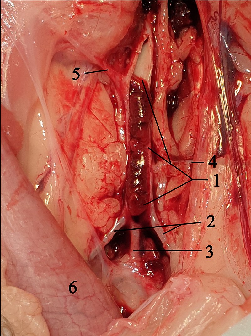 Hypertrophic Cardiomyopathy