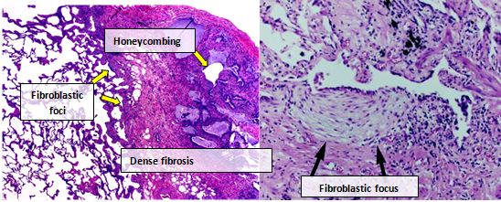 Idiopathic Pulmonary Fibrosis