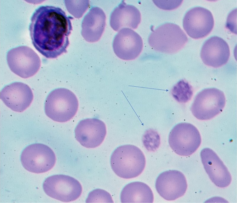 Immune Thrombocytopenia Purpura