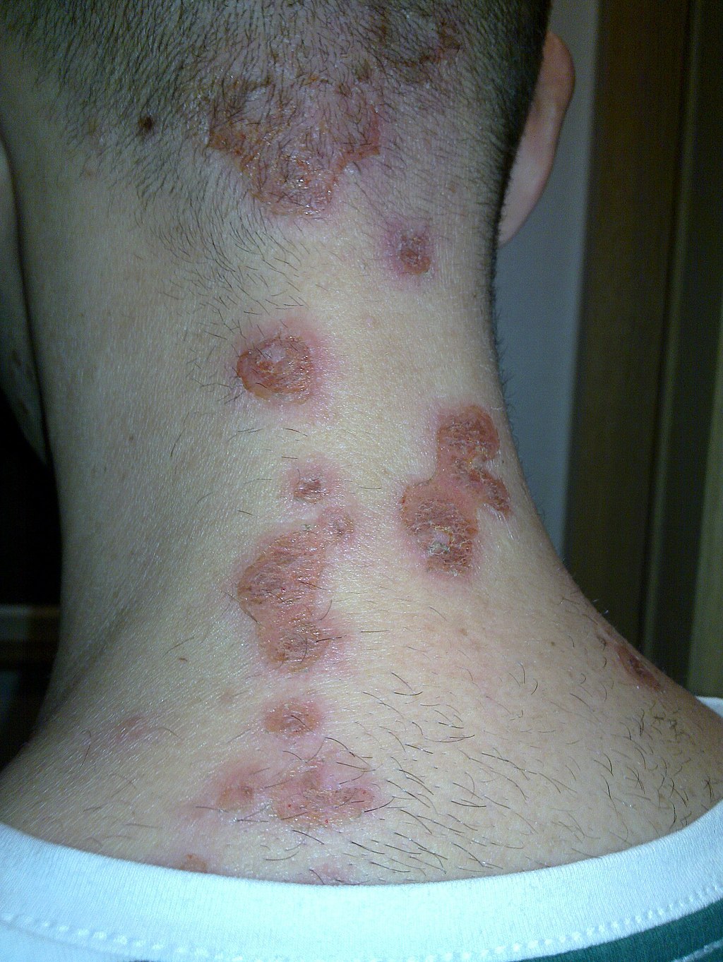 Impetigo