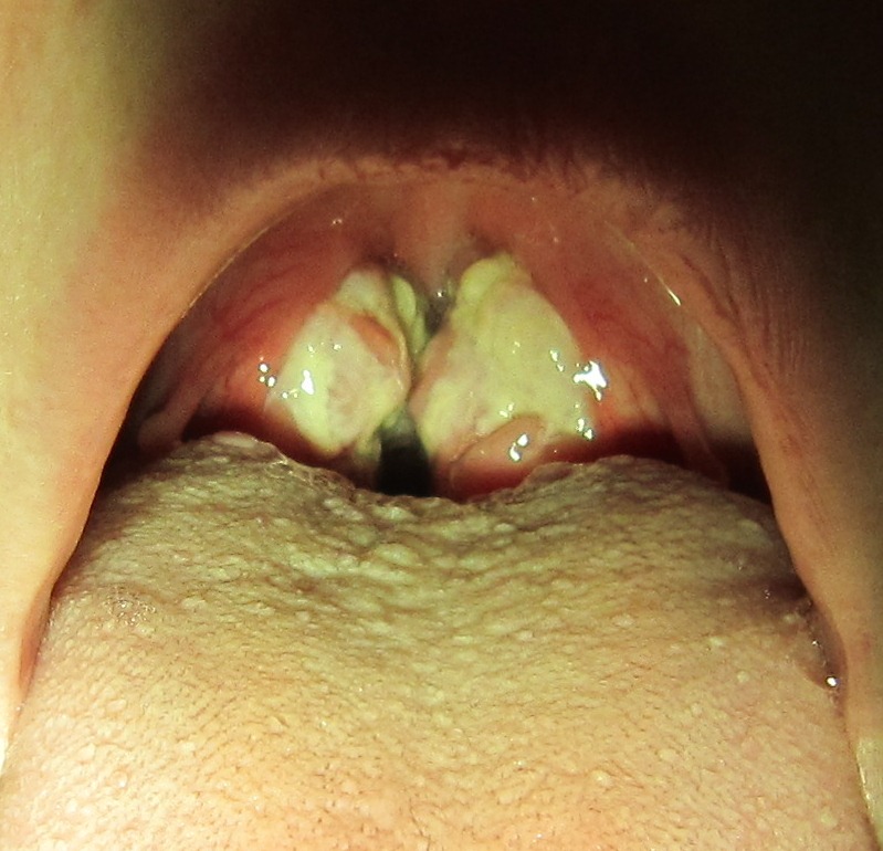 Infectious Mononucleosis