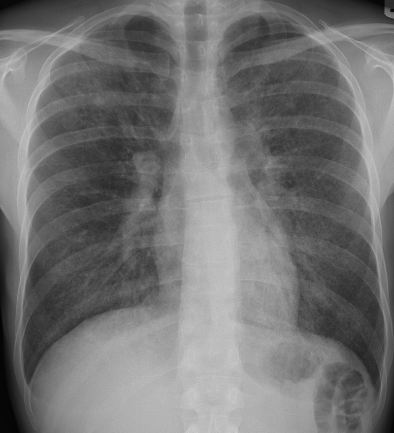 Interstitial Pneumonia