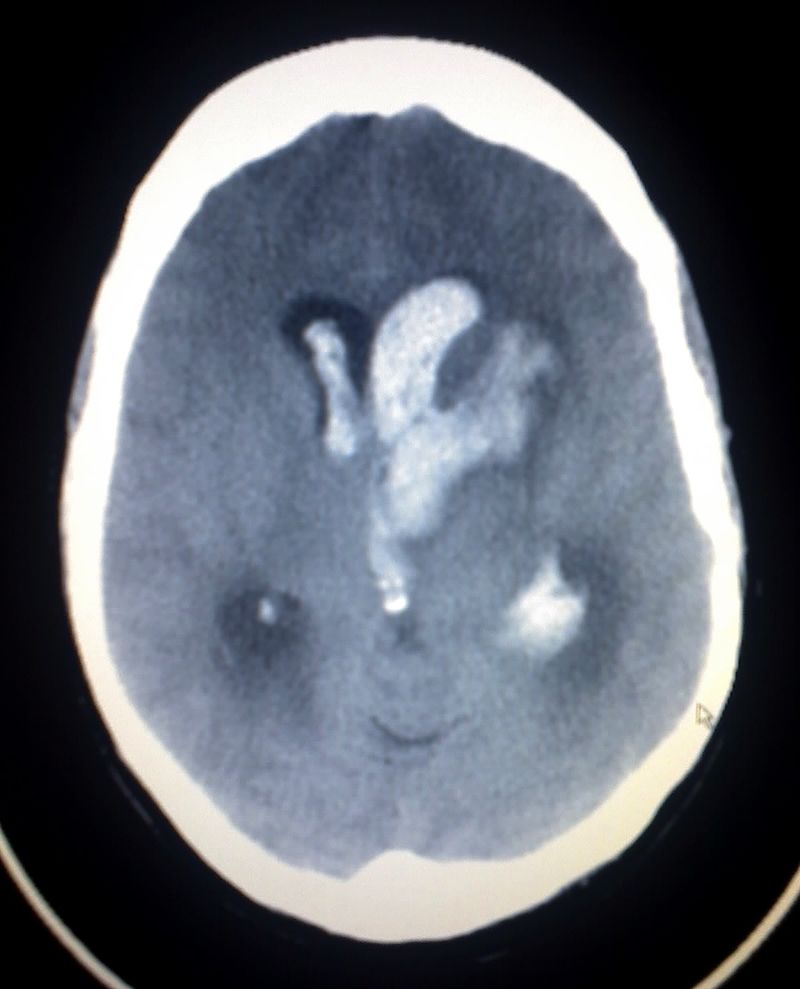 Intracerebral Hemorrhage