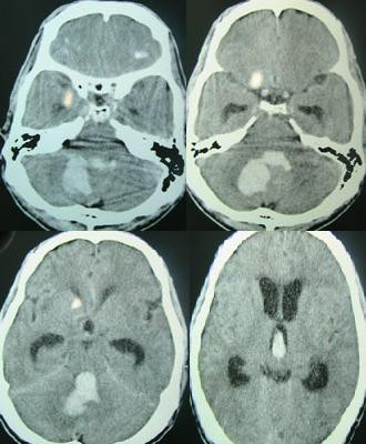 Intracerebral Hemorrhage
