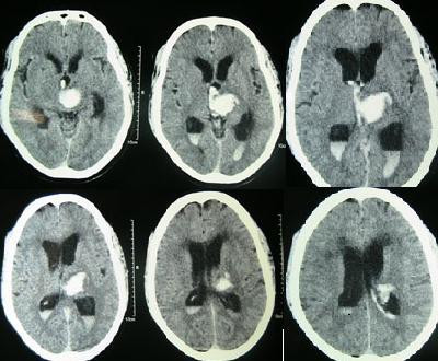Intracerebral Hemorrhage