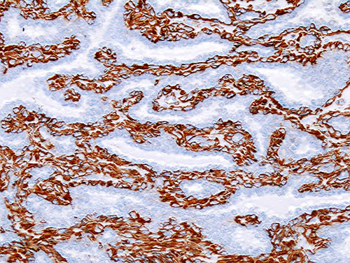 Intraductal Papilloma