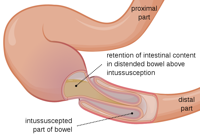 Intussusception
