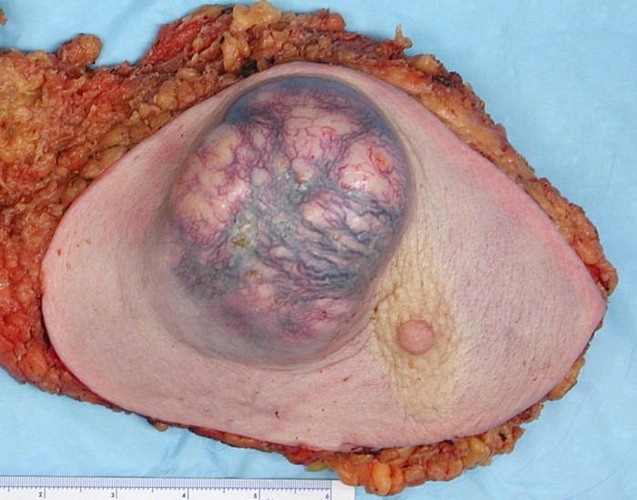 Invasive Ductal Carcinoma
