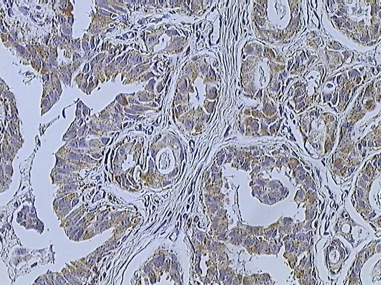 Invasive Ductal Carcinoma