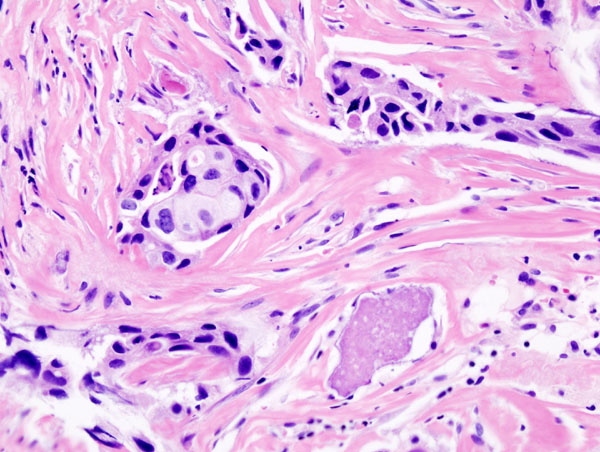 Invasive Ductal Carcinoma
