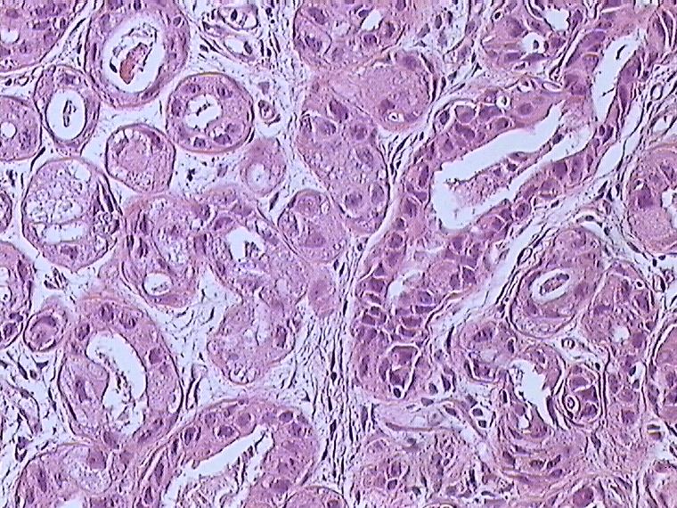 Invasive Ductal Carcinoma