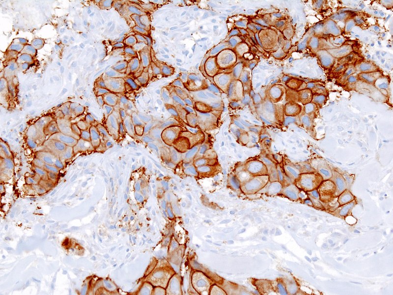 Invasive Ductal Carcinoma