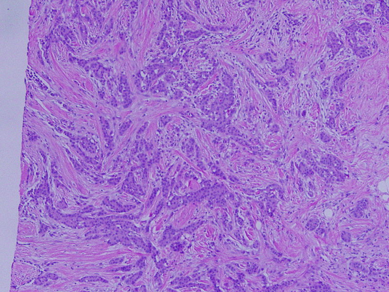Invasive Ductal Carcinoma
