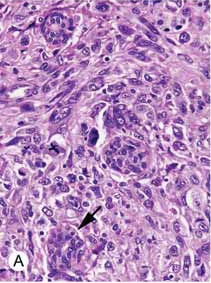 Invasive Ductal Carcinoma