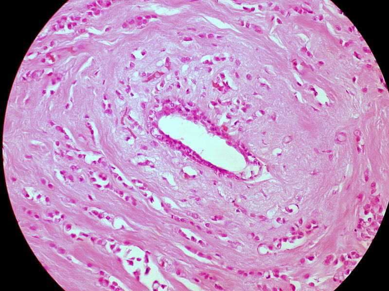 Invasive Lobular Carcinoma